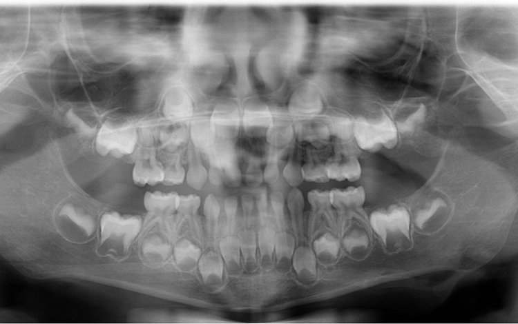 Denti del giudizio